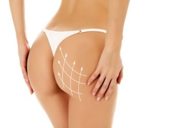 Injertos de grasa para aumentar los glúteos