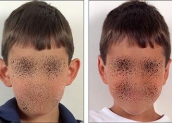 Las orejas que sobresalen excesivamente de la cabeza otoplastias para la autoestima