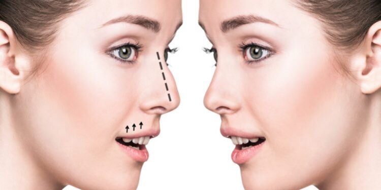 ¿Qué puede hacer una rinoplastia?