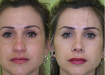 Adiós a narices respingonas e iguales. Hola a tu rostro único