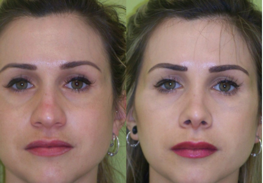 Adiós a narices respingonas e iguales. Hola a tu rostro único