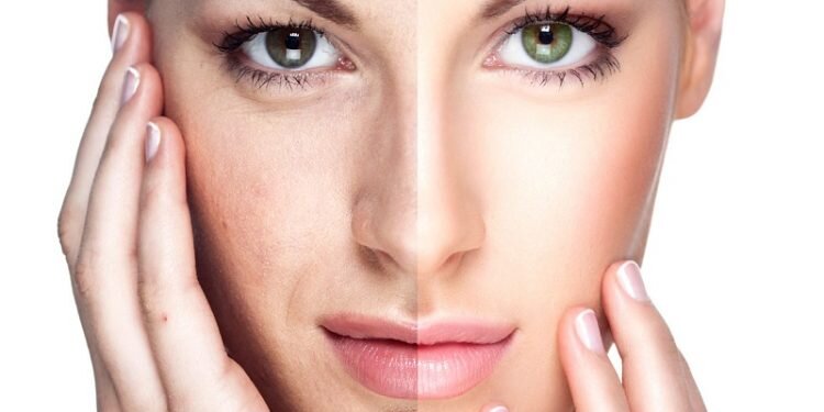 Mesoterapia facial, cuello, escote y manos: